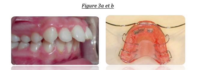 Mâchoire du haut trop en avant par rapport à celle du bas : « dents en avant »
