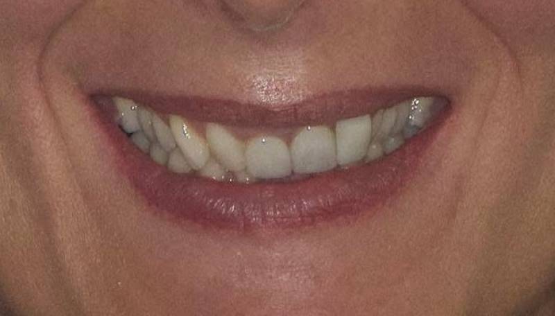 Situation avant le traitement dentaire par le cabinet dentaire Maupassant Marseille