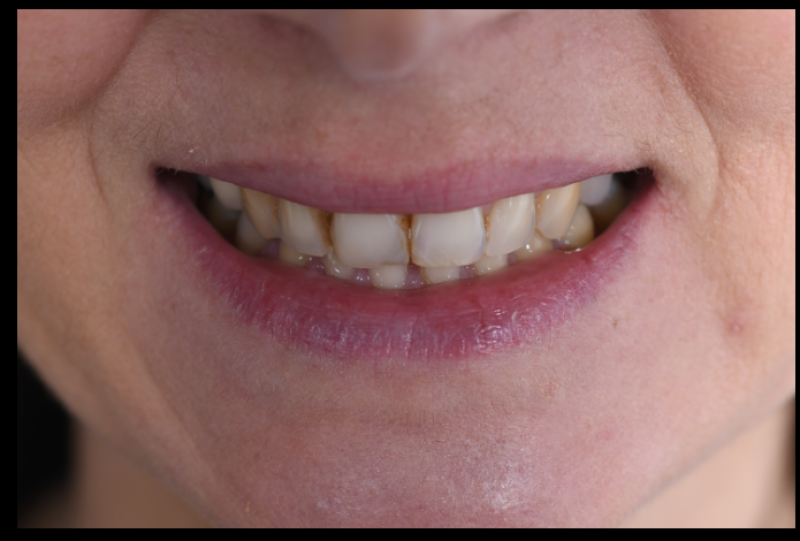 Sourire avant la pose des facettes dentaires