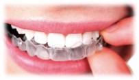 Aligneurs transparents : Invisalign