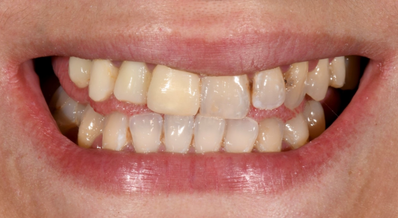 Sourire avant traitement par le cabinet dentaire Maupassant