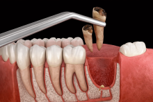 Notre zone d'activité pour ce service Tarif implants dentaires pour remplacer son dentier