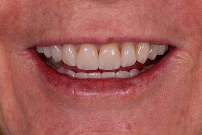 Notre zone d'activité pour ce service Pose de facettes dentaires blanches haut de gamme pour transformer son sourire naturellement
