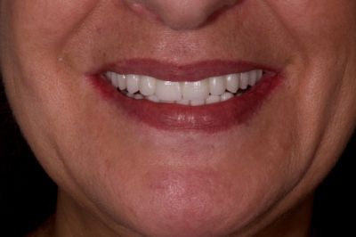 Notre zone d'activité pour ce service Tarif implants dentaires pour remplacer son dentier