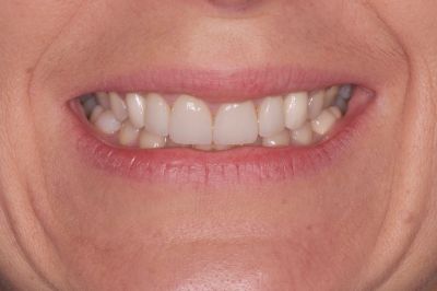 Notre zone d'activité pour ce service Pose d'implants dentaires pas chers