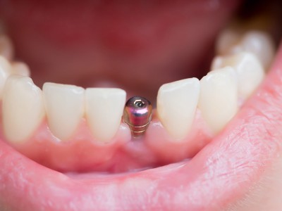 Notre zone d'activité pour ce service Dentiste pour greffe et reconstruction osseuse