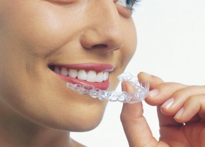 Appareil dentaire pour adulte invisible Marseille Invisalign