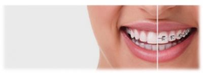 Notre zone d'activité pour ce service Évolution du sourire avec Invisalign : changements visibles avant/après à 3 mois, 6 mois et 1 an de traitement