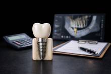 Notre zone d'activité pour ce service Tarif implants dentaires pour remplacer son dentier