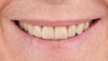 Notre zone d'activité pour ce service Prix pour la pose de facettes dentaires personnalisées en céramique pour corriger des dents qui se chevauchent