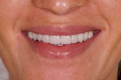 Notre zone d'activité pour ce service Blanchiment des dents pas cher